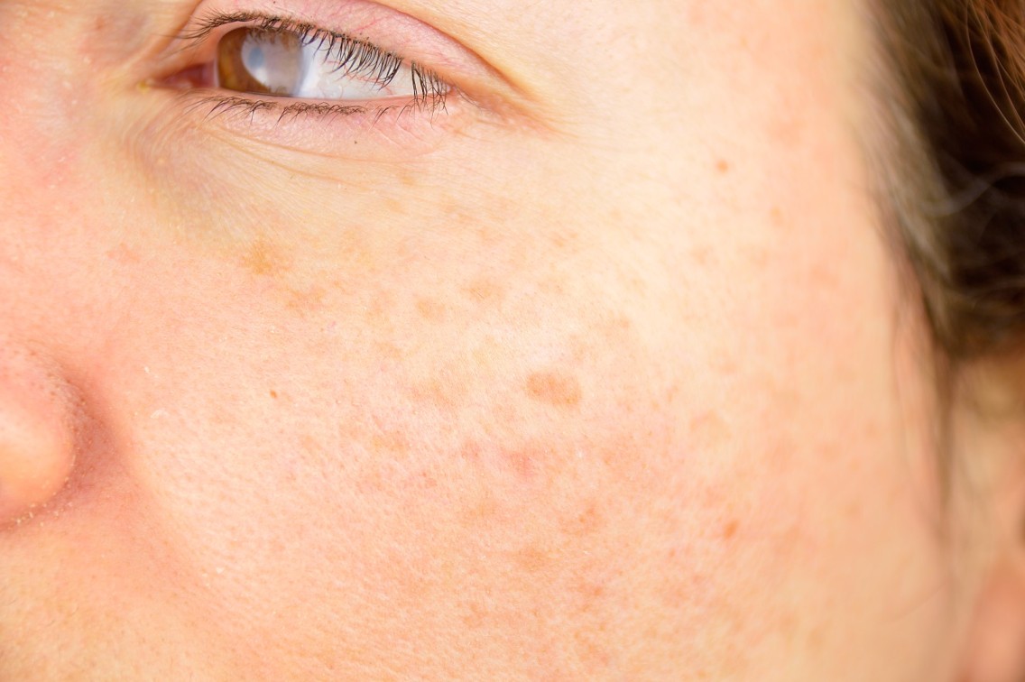 age spots (1)